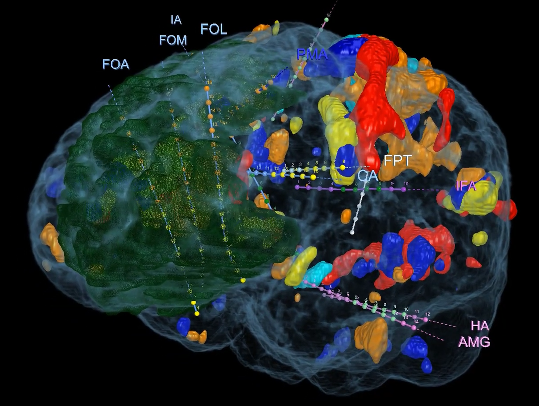 VR Tech Lets Corewell Health Patients ‘fly’ Through The Brain ...